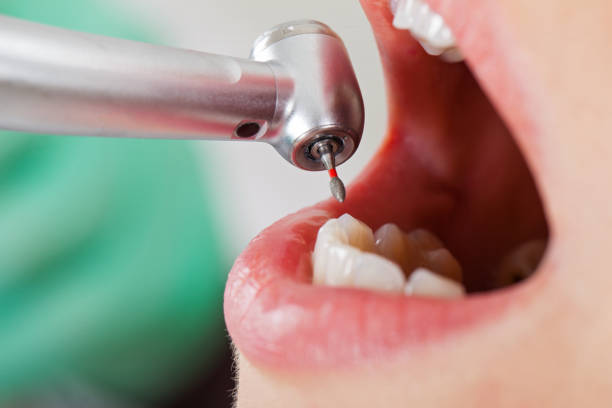 Best Broken or Chipped Tooth Repair in Shelby, OH